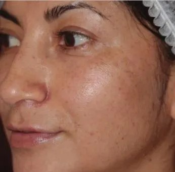 Before Treatment