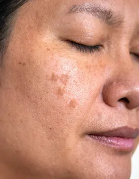 Before Treatment